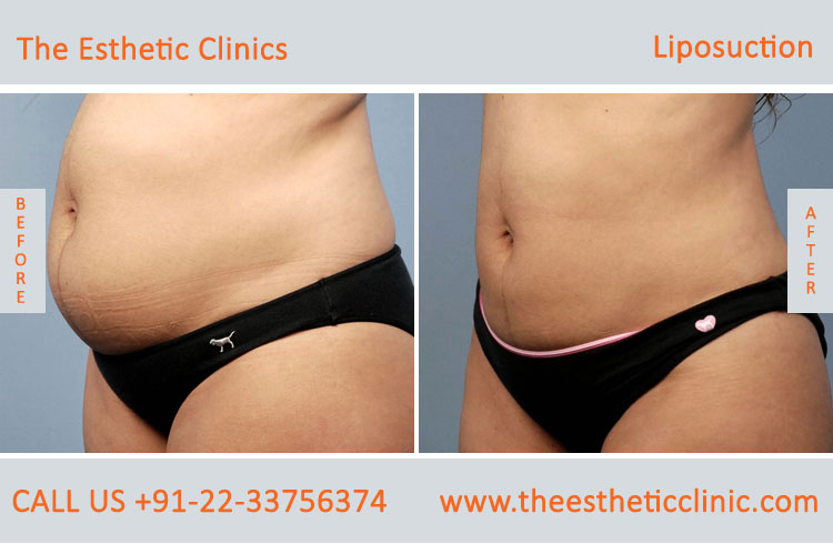 Liposuction Fat Removal Treatment before after photos in mumbai india (4)